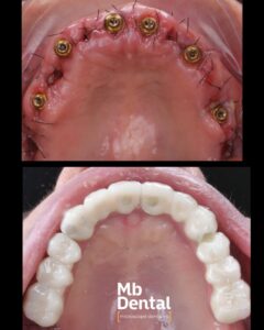 Dantura fixa pe implanturi ( All on 6 de zirconiu si titan) realizate de dr. Marius Bud in clinica Mb Dental Cluj