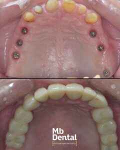 Lucrari dentare din ceramica si zirconiu realizate pe dinti si implanturi in clinica Mb Dental de Dr. Marius Bud