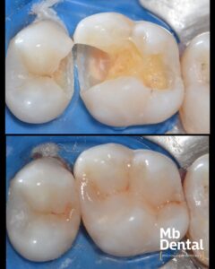 Plombe/ obturatii realizate anatoform cu precizie la microscop de dr. Marius Bud la clinica Mb Dental Cluj