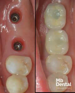 Implant dentar Megagen si coroana zirconiu realizata de dr. Marius Bud la Mb Dental