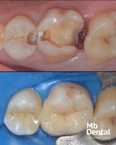 Tratamentul unor carii dentare la microscop operator dentar de dr. Marius Bud la clinica stomatologica Mb Dental Cluj