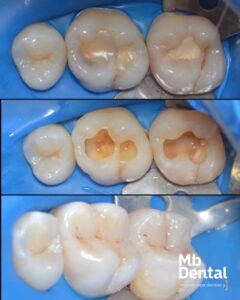 Obturatii (plombe) realizate la microscop in clinica Mb Dental Cluj