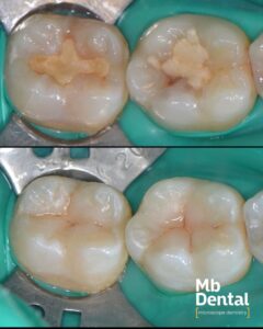 Inlocuirea unor obturatii / plombe vechi cu unel noi realizate la microscop operator dentar de dr. Marius Bud la clinica stomatologica Mb Dental Cluj