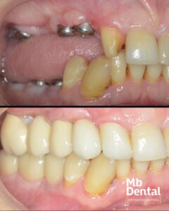 Implant dentar Straumann si coroana zirconiu realizata de dr. Marius Bud la Mb Dental