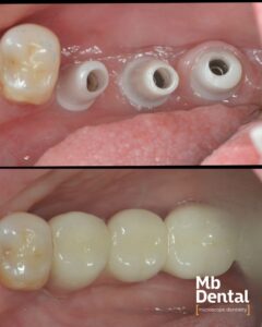 Implant dentar Megagen, bont zirconiu si coroane zirconiu cimentate realizate de dr. Marius Bud la Mb Dental