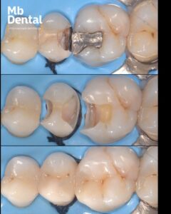 plombe (obturatii) realizate la microscop operator dentar de dr. Marius Bud la clinica stomatologica Mb Dental Cluj