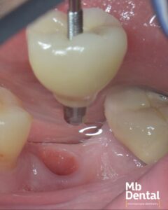 Implant dentar Megagen si coroana zirconiu insurubata realizata de dr. Marius Bud la Mb Dental