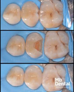 plombe (obturatii) realizate la microscop operator dentar de dr. Marius Bud la clinica stomatologica Mb Dental Cluj